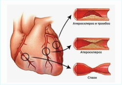 Ишемическая болезнь сердца в пожилом возрасте опаснее для женщин